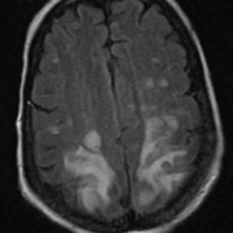 Mri Brain Showed T2flair Signal Hyperintensity Over The Bilateral