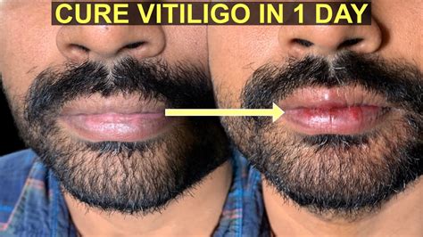 Lip Vitiligo Permanent Solution By Machu Tattoos Bangalore Youtube