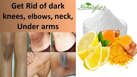 How To Get Rid Of Dark Knees Elbows Neck And Underarmsnaturally And