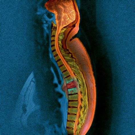 Bone Cancer Mri Photograph By Du Cane Medical Imaging Ltd Pixels