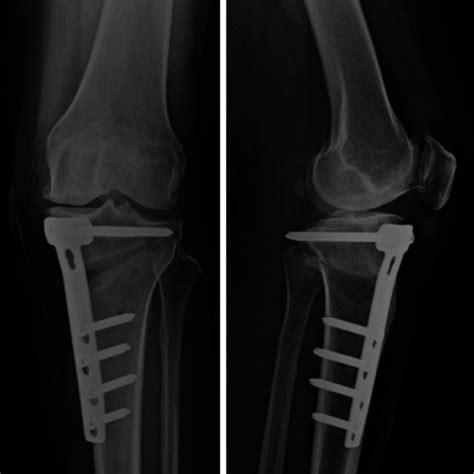 High Tibial Osteotomy Was Performed By The Medial Opening Wedge