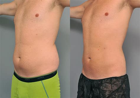 Male Liposuction Nyc