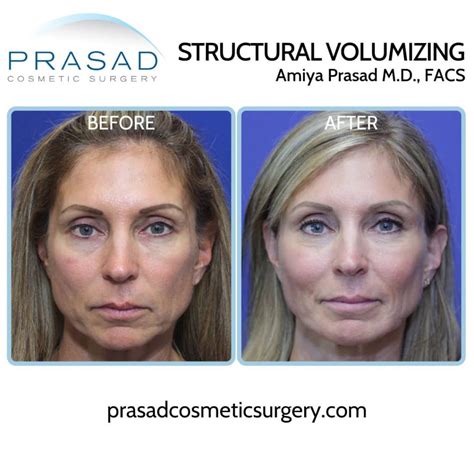 Asymmetrical Face Surgery Before And After