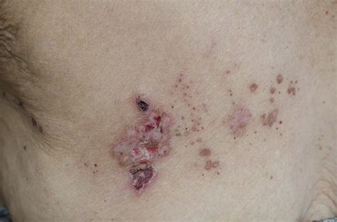 Are There Foods That Heal Shingles Livestrongcom