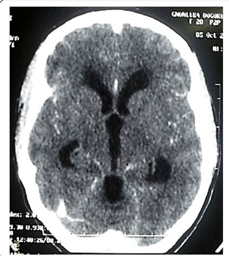 Ct Scan Showing Hydrocephalus With Lateral Third And Fourth Ventricle