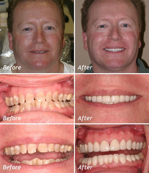 Before And After Cosmetic Dentistry Veneers Perfect Teeth Dental