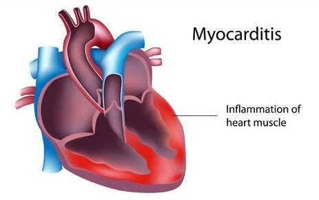 9, 10 esfandiarei and mcmanus 8 proposed that the pathophysiology of viral myocarditis. Where is Your Heart Located? Chest Pains Related with Your Heart
