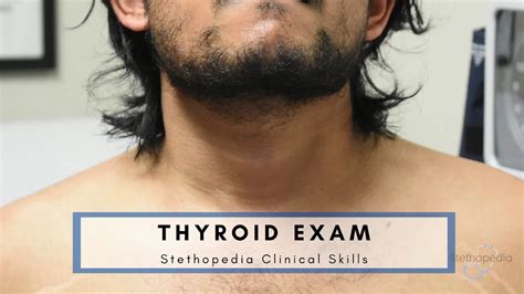 Thyroid Osce Exam Stethopedia Youtube