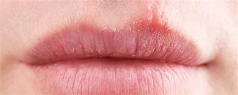 如何防止冬季嘴唇干裂 冬季怎样防止嘴唇干裂知秀网