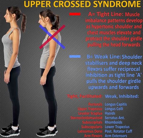 Upper Crossed Syndrome Upper Cross Syndrome Body Anatomy Muscle