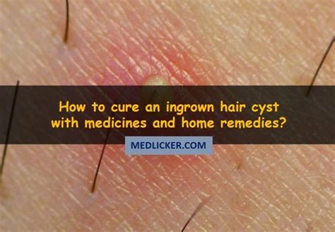 Ingrown Hair Cyst And How To Cure It Ingrown Hair Cyst Ingrown Hair