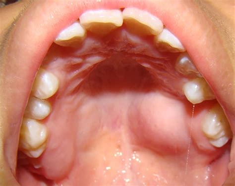 Adenoma Pleomorfo Adenoma Pleomorfo Clínica Dental Borrás
