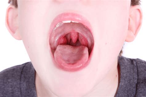 Tonsil Stone Removal Vs Tonsillectomy Dr Gan Eng Cern