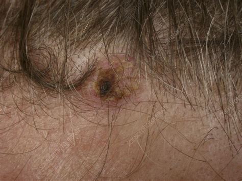 Basal Cell Carcinoma Stock Image C0063992 Science Photo Library