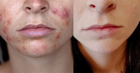 Hormonal Acne Treatment Clear Skin In 4 Months