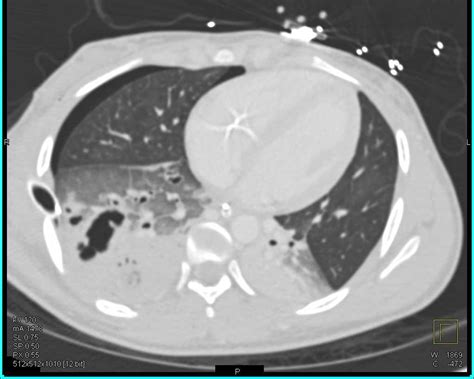 Pulmonary Contusion And Laceration And Liver Laceration Sp Trauma