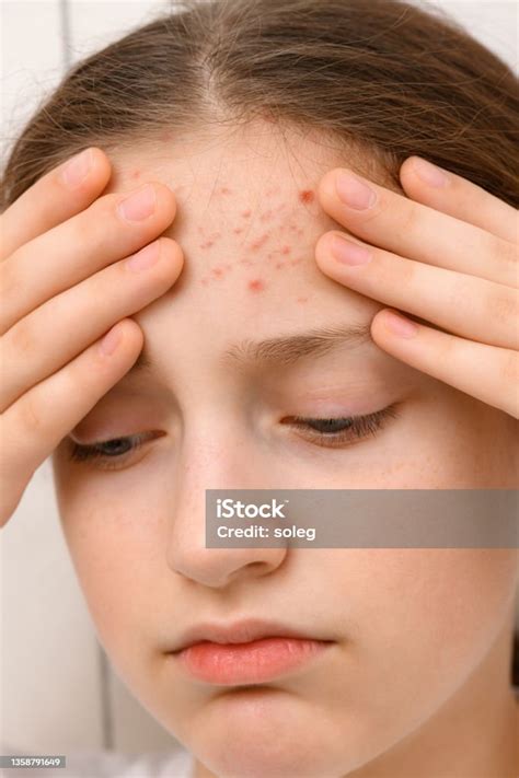 Portrait Of A Teenage Girl Touches Her Face With Pimples Acne On The
