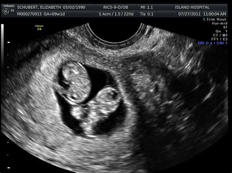 Identical Twins Ultrasound 8 Weeks Ultrahang Felvételek Ikrek
