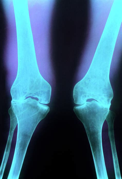 X Ray Of Knee Joints With Rheumatoid Arthritis Photograph By Princess Margaret Rose Orthopaedic