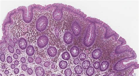 Melanosis Coli Atlas Of Pathology