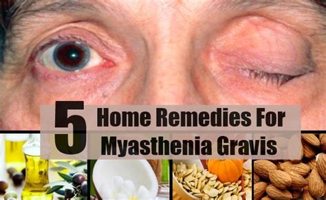 The first symptoms of myasthenia gravis often involve the eyes. 5 Myasthenia Gravis Home Remedies, Natural Treatments And ...