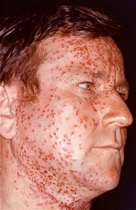 Eczema Atopic Dermatitis Photos Aaaai