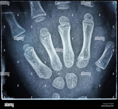 Hand Xray Child Hi Res Stock Photography And Images Alamy