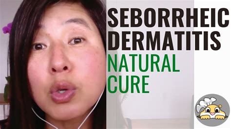 Treat Seborrheic Dermatitis Naturally 3 Simple Tips Youtube