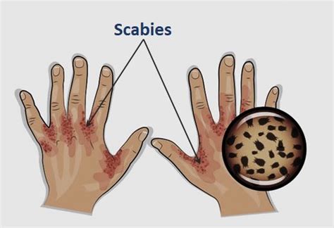 Scabies Rash Distribution