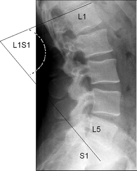 New Method For Predicting The Lumbar Lordosis Angle In Skeletal
