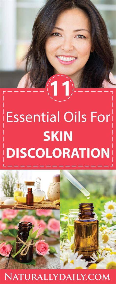 Top 11 Essential Oils For Skin Discoloration Hyperpigmentation And Melasma