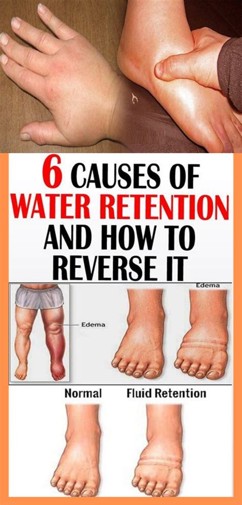 6 Causes Of Water Retention And How To Reverse It Healhty And Tips