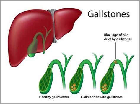 Gallbladder Disorders And Gallstone Pancreatitis Greenview Medical Center
