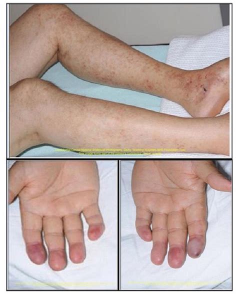 Gangrenous Digital Infarcts In A Severe Case Of Cutaneous Polyarteritis