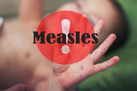 Measles Outbreak And Immunization Adbontures