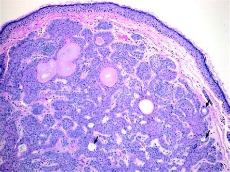 Skin Adnexal Neoplasms—part 1 An Approach To Tumours Of The