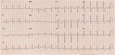 Ekg tracing please refer to the ekg tracing below if you are not familiar with the labeling of the ekg waveforms. Killer ECG Patterns • LITFL Medical blog • ECG Library