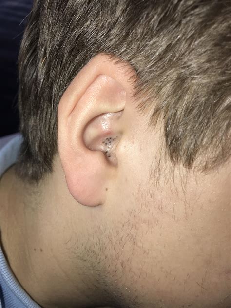 Infected Blackhead In Ear