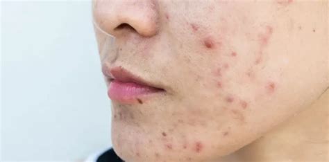 Cystic Acne Symptoms Causes And Treatment Options