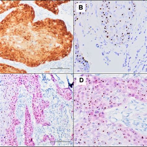Representative Results Of An Oropharyngeal Squamous Cell Carcinoma With