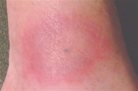 After a tick bite, a small swelling or spot with in the middle a red dot where the tick used to be can be seen on the skin. lyme disease--tick identification--erythema migrans ...