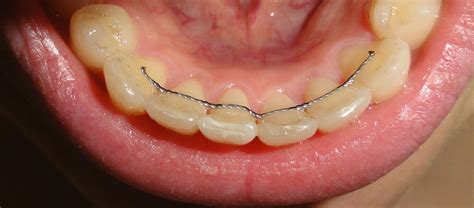 Orthodontic Retention Patrick Turley Dds Manhattan Beach Ca