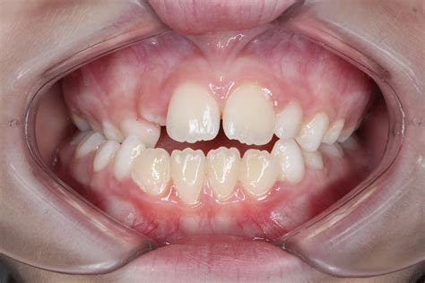 A crossbite is a type of teeth misalignment that happens when a healthy bite is distorted, and your teeth do not fit together as they should. Crossbite Treatment Using Braces in Miami & More
