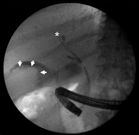Occlusion Cholangiogram Obtained During Ercp Showing Adequate Filling