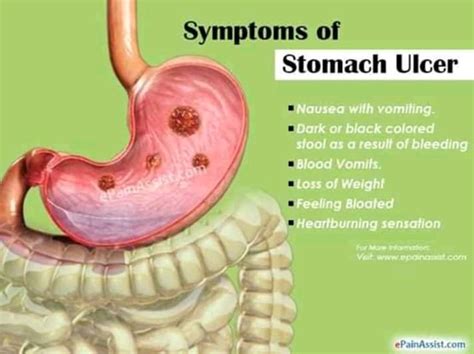 Stomach Ulcers Diet