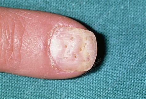 Psoriasis Pitting Of A Fingernail Stock Image M2400122 Science