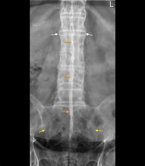 Ankylosing Spondylitis Dagger Sign Radiology At St Vincents