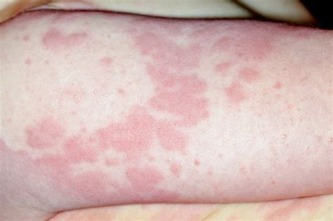 Food Allergy Skin Rash Images