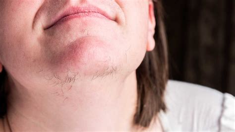 Here Are 6 Reasons Why You Get Hair On The Chin Healthshots