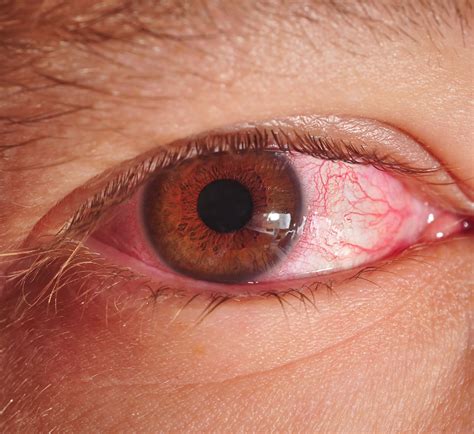 Pictures Of Pink Eye Conjunctivitis